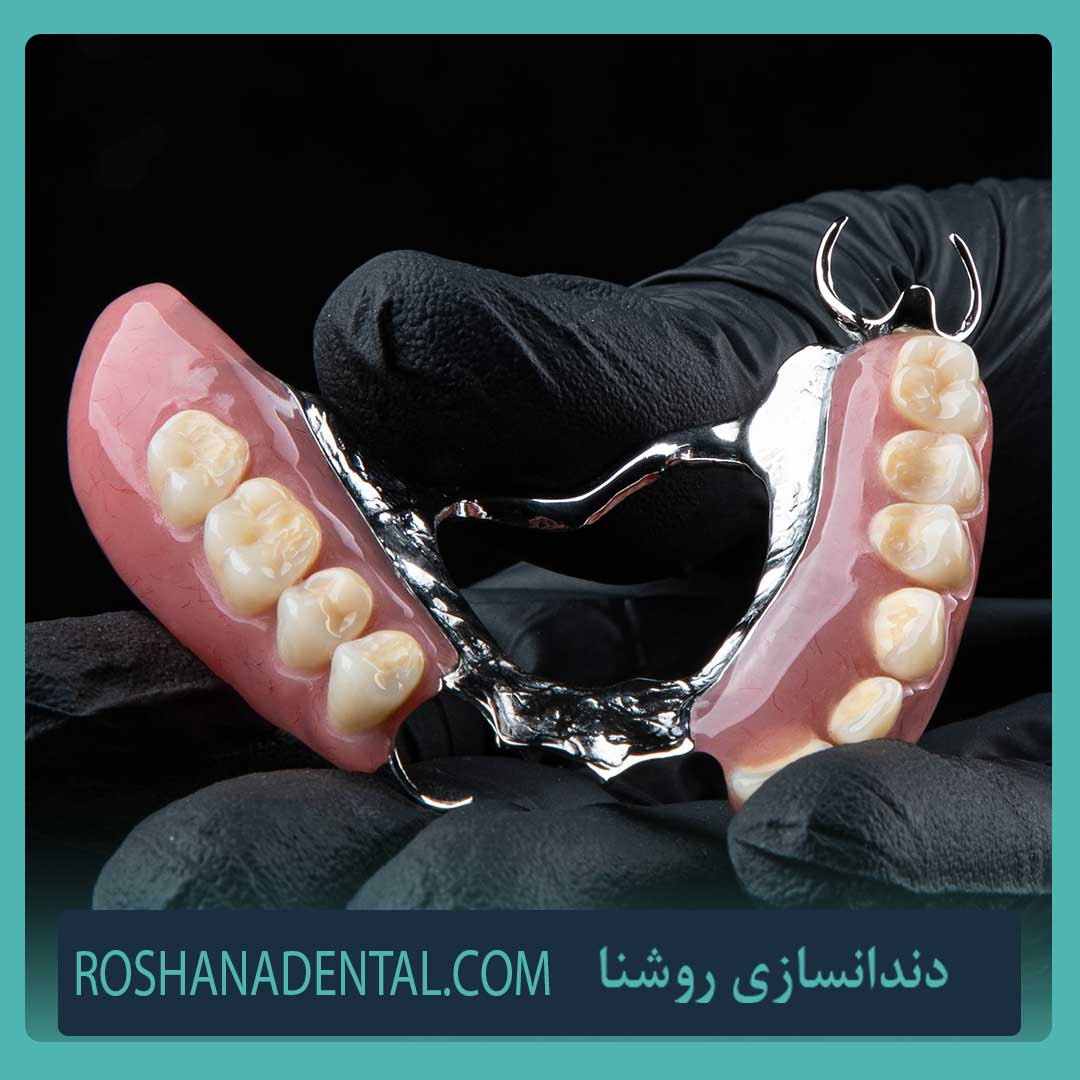 پروتز پارسیل کروم‌کبالت 01 در روشنا
