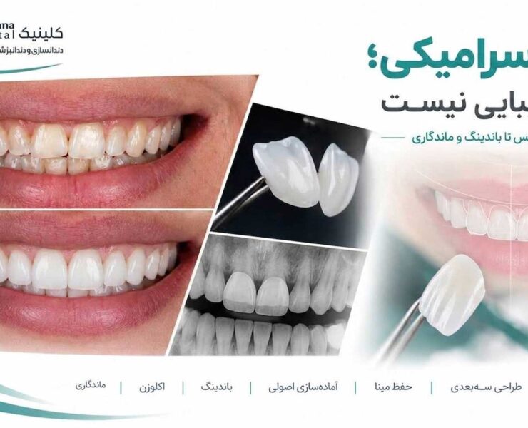 تصویر شاخص مقاله ونیر سرامیکی