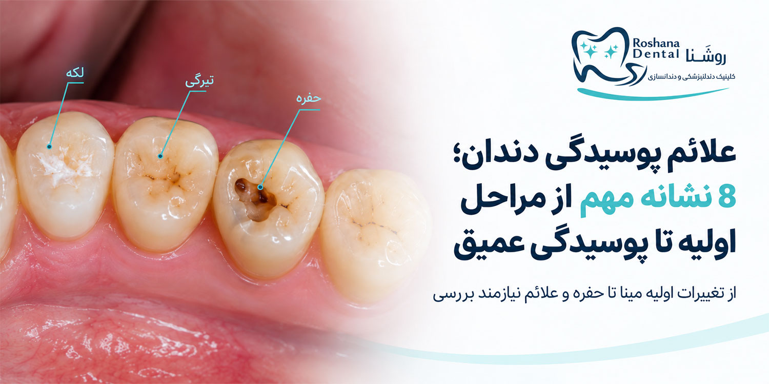 علائم پوسیدگی دندان از لکه و تیرگی تا حفره در دندان‌های طبیعی
